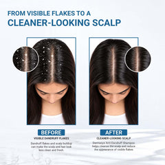 Before and after graphic showing visible scalp flakes and a cleaner-looking scalp