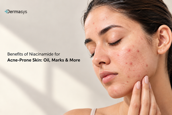 Top 5 Benefits of Niacinamide for Acne-Prone Skin