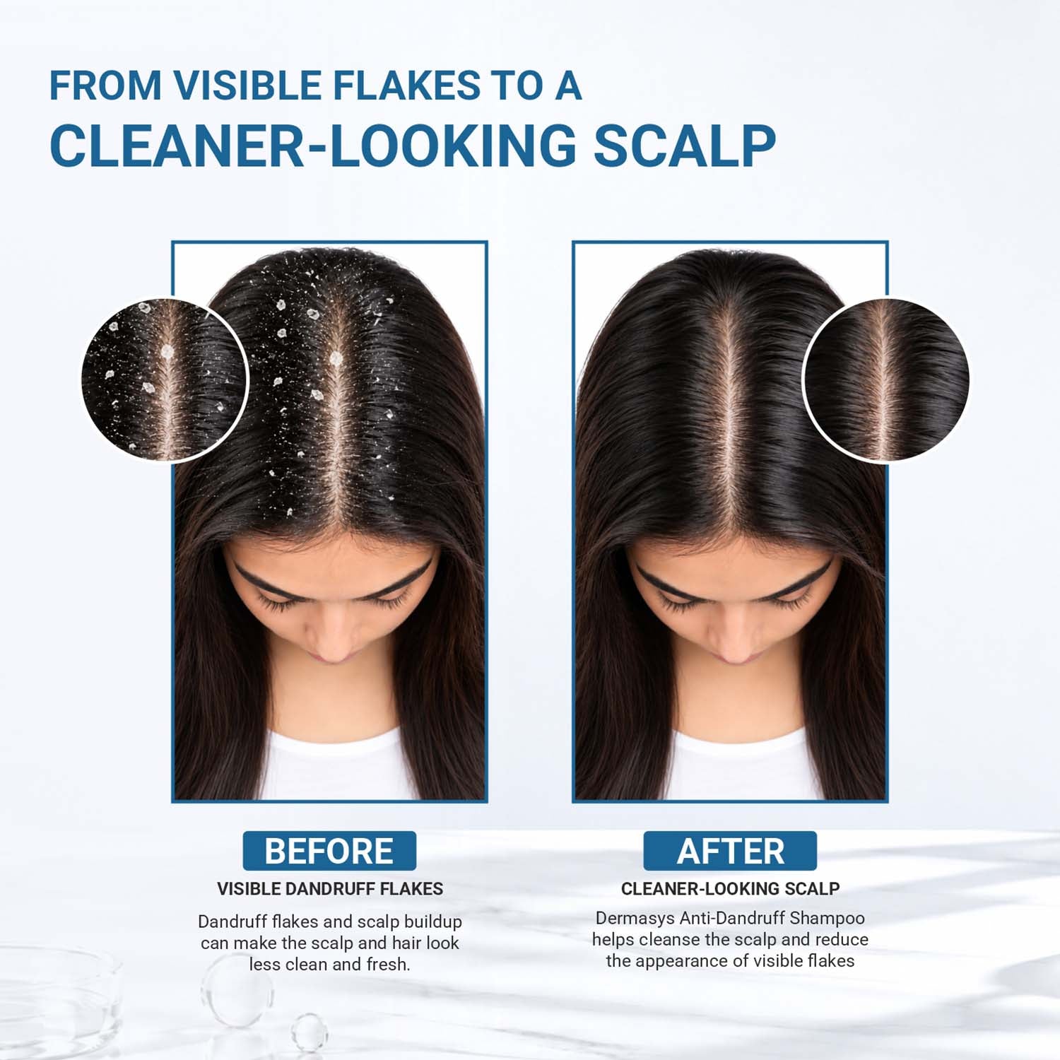 Before and after graphic showing visible scalp flakes and a cleaner-looking scalp