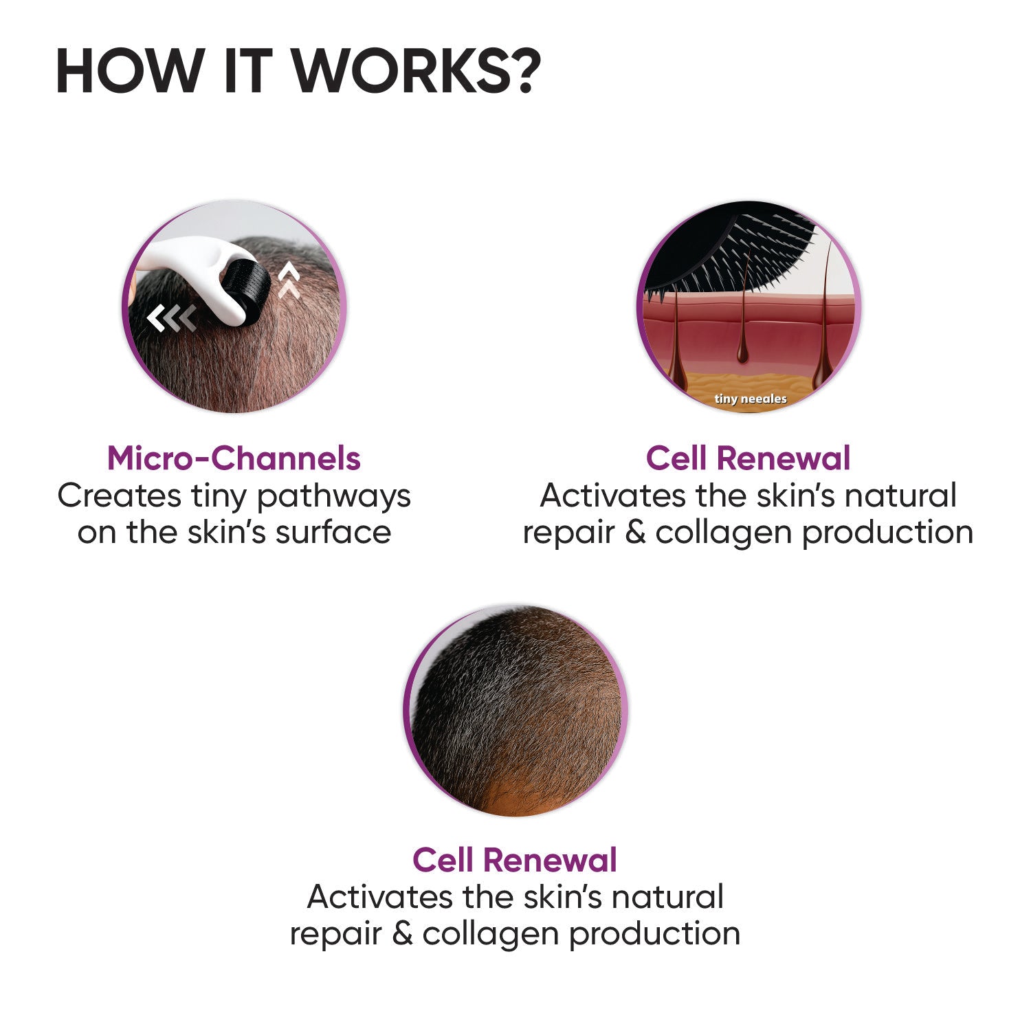 Derma roller for receding hairline with visible hair regrowth results